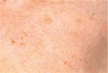 Little dark patches similar to large freckles appearing on your skin 