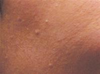You may have noticed hard small white bumps on your skin and assume 