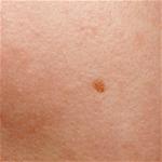 What Are Age Spots On Your Arms What Are Age Spots On Your Arms