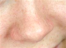 Enlarged Pores