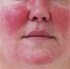 Rosacea