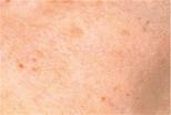 Age-Spots-on-Skin